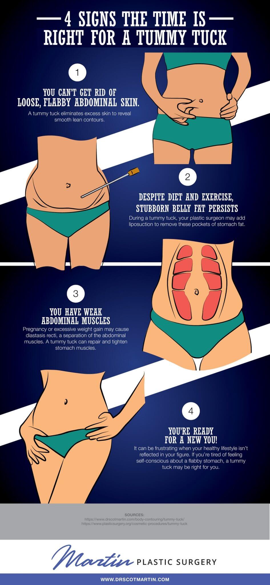 Tummy tuck