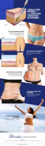 5 Really Good Reasons to Finally Book Your Liposuction Appointment  [Infographic]