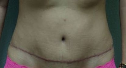 Tummy Tuck Patient Photo - Case 47 - after view