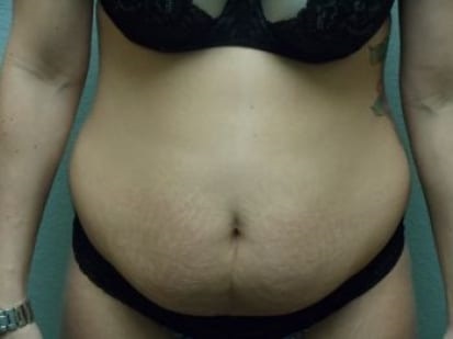Tummy Tuck Patient Photo - Case 26 - before view-