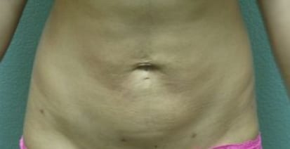 Liposuction Patient Photo - Case 54 - after view-0