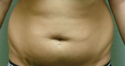 Liposuction Patient Photo - Case 54 - before view-0