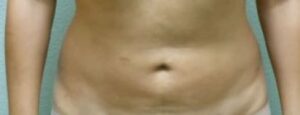 Liposuction - Case 52 - After