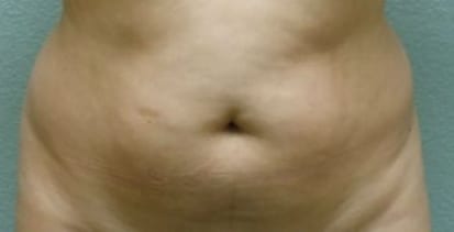 Liposuction Patient Photo - Case 52 - before view-