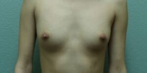 Breast Augmentation - Case 53 - Before