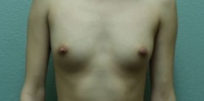 Breast Augmentation Patient Photo - Case 53 - before view-0