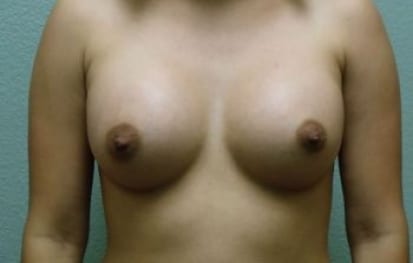 Breast Augmentation Patient Photo - Case 50 - after view
