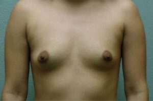 Breast Augmentation - Case 50 - Before