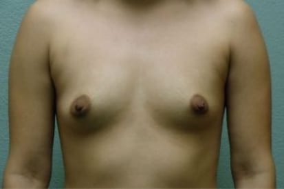 Breast Augmentation Patient Photo - Case 50 - before view-