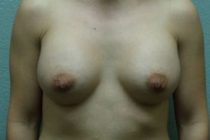 Breast Augmentation Patient Photo - Case 48 - after view-0