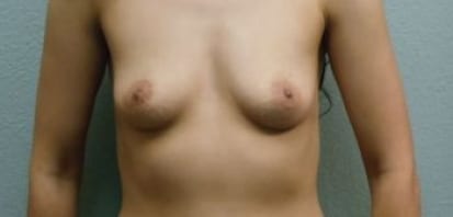 Breast Augmentation Patient Photo - Case 40 - before view-