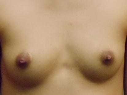 Breast Augmentation Patient Photo - Case 22 - before view-0