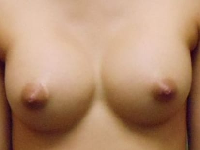 Breast Augmentation Patient Photo - Case 22 - after view-0