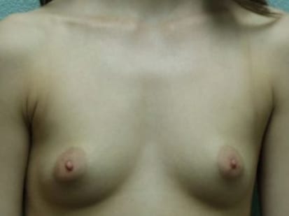 Breast Augmentation Patient Photo - Case 21 - before view-0