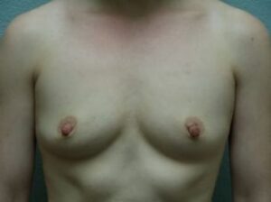Breast Augmentation - Case 19 - Before