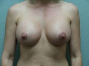 Breast Augmentation - Case 10 - After