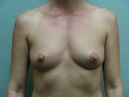 Breast Augmentation Patient Photo - Case 10 - before view-