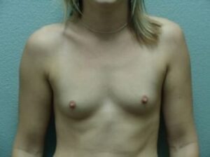Breast Augmentation - Case 6 - Before