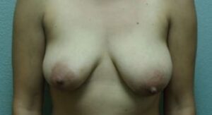 Breast Augmentation & Lift - Case 44 - Before