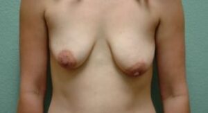 Breast Augmentation & Lift - Case 43 - Before