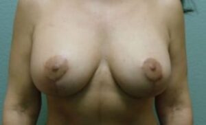 Breast Augmentation & Lift - Case 36 - After