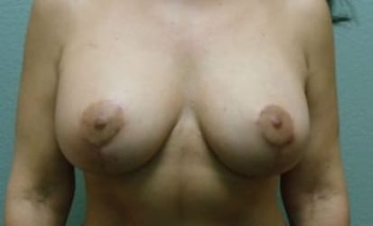 Breast Augmentation & Lift Patient Photo - Case 36 - after view
