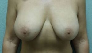 Breast Augmentation & Lift - Case 36 - Before