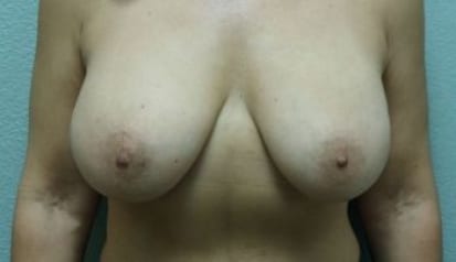 Breast Augmentation & Lift Patient Photo - Case 36 - before view-0