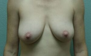 Breast Augmentation & Lift - Case 33 - Before