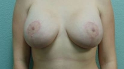 Breast Augmentation & Lift Patient Photo - Case 32 - after view-0