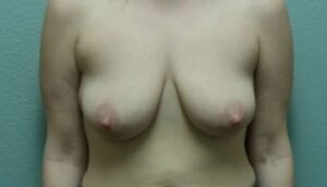 Breast Augmentation & Lift - Case 31 - Before
