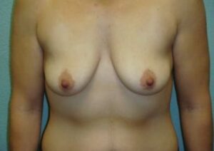 Breast Augmentation & Lift - Case 30 - Before