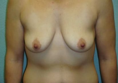 Breast Augmentation & Lift Patient Photo - Case 30 - before view-