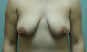 Breast Augmentation & Lift - Case 28 - Before