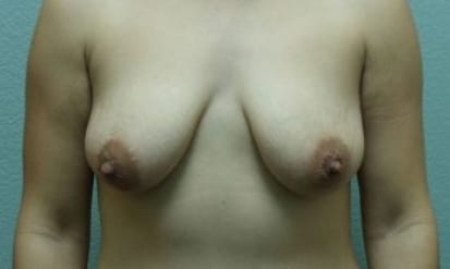 Breast Augmentation & Lift Patient Photo - Case 28 - before view-