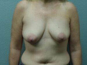 Breast Augmentation & Lift - Case 14 - Before