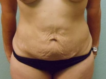 Tummy Tuck Patient Photo - Case 11 - before view-