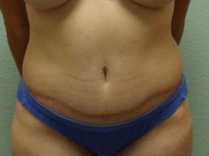 Tummy Tuck Patient Photo - Case 11 - after view