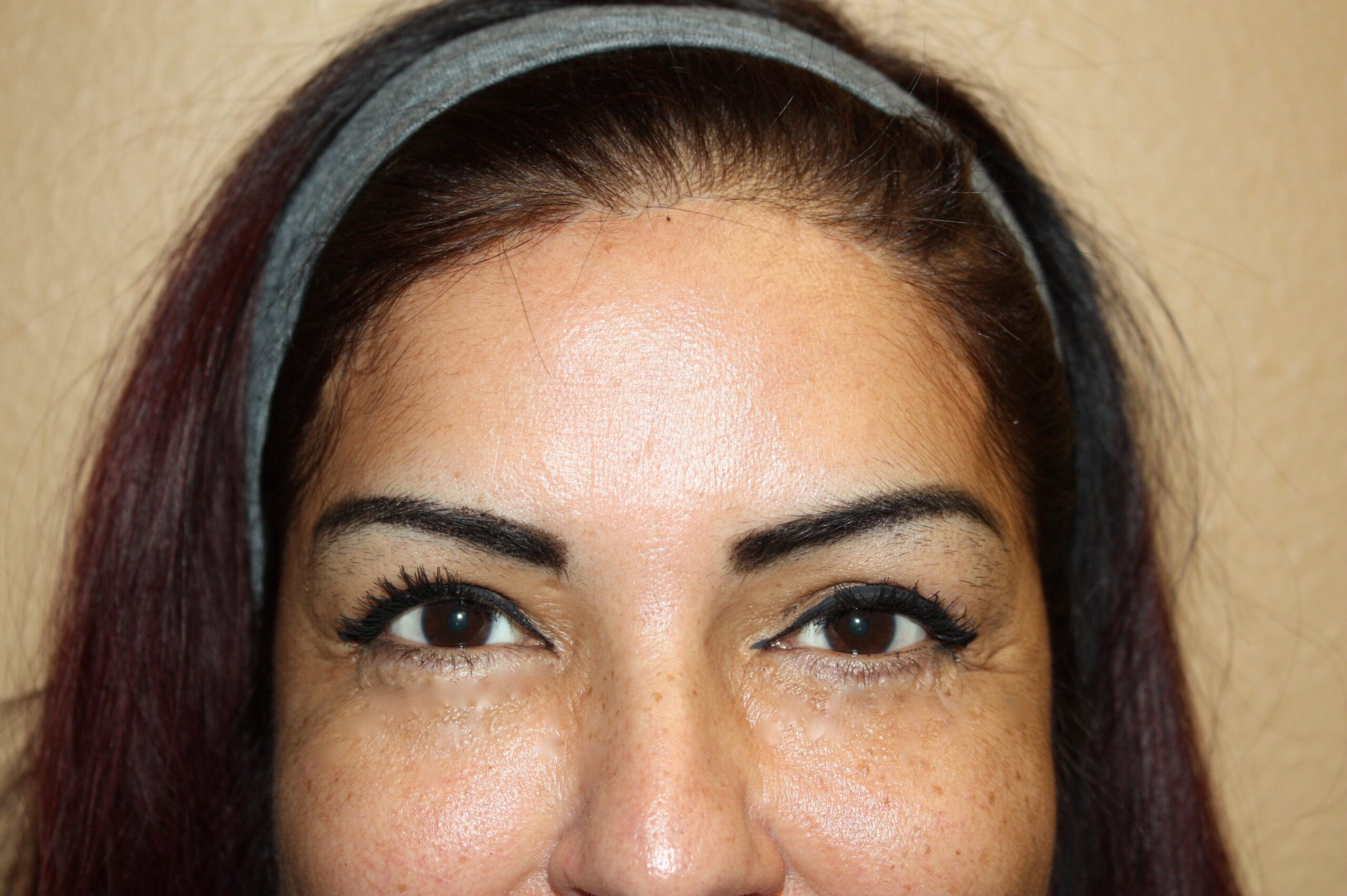 Brow Lift Patient Photo - Case 2348 - after view-0