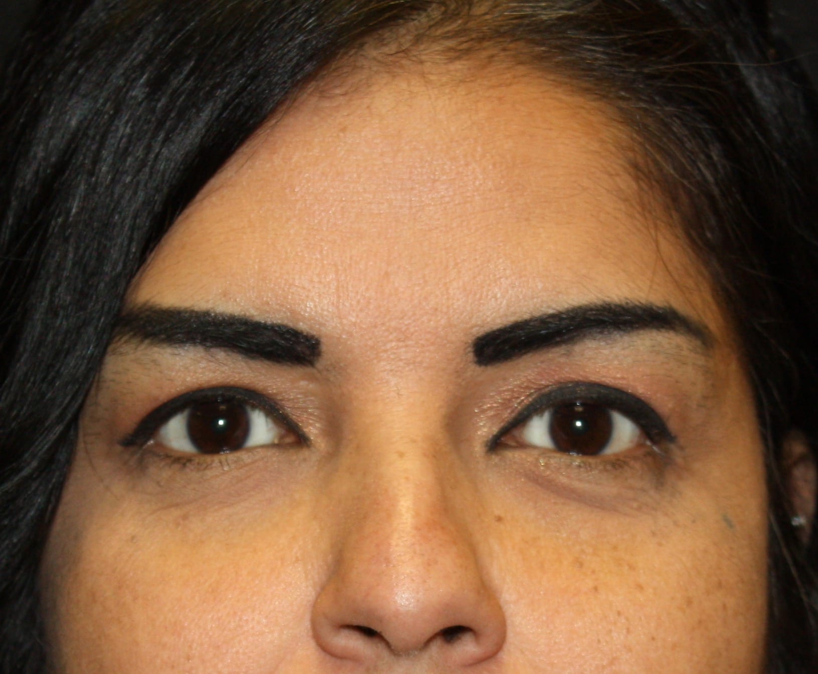 Brow Lift Patient Photo - Case 2348 - before view-0