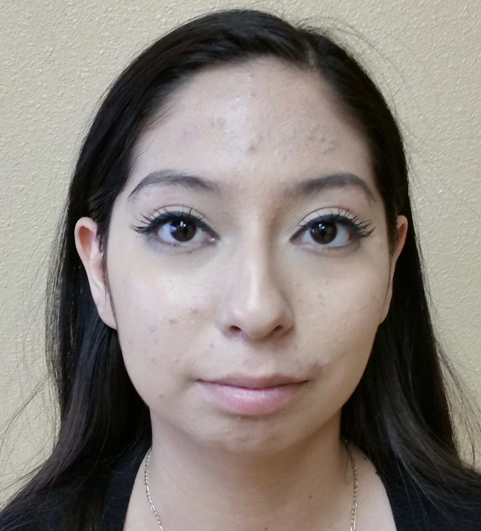 Chin Augmentation Patient Photo - Case 2367 - before view-
