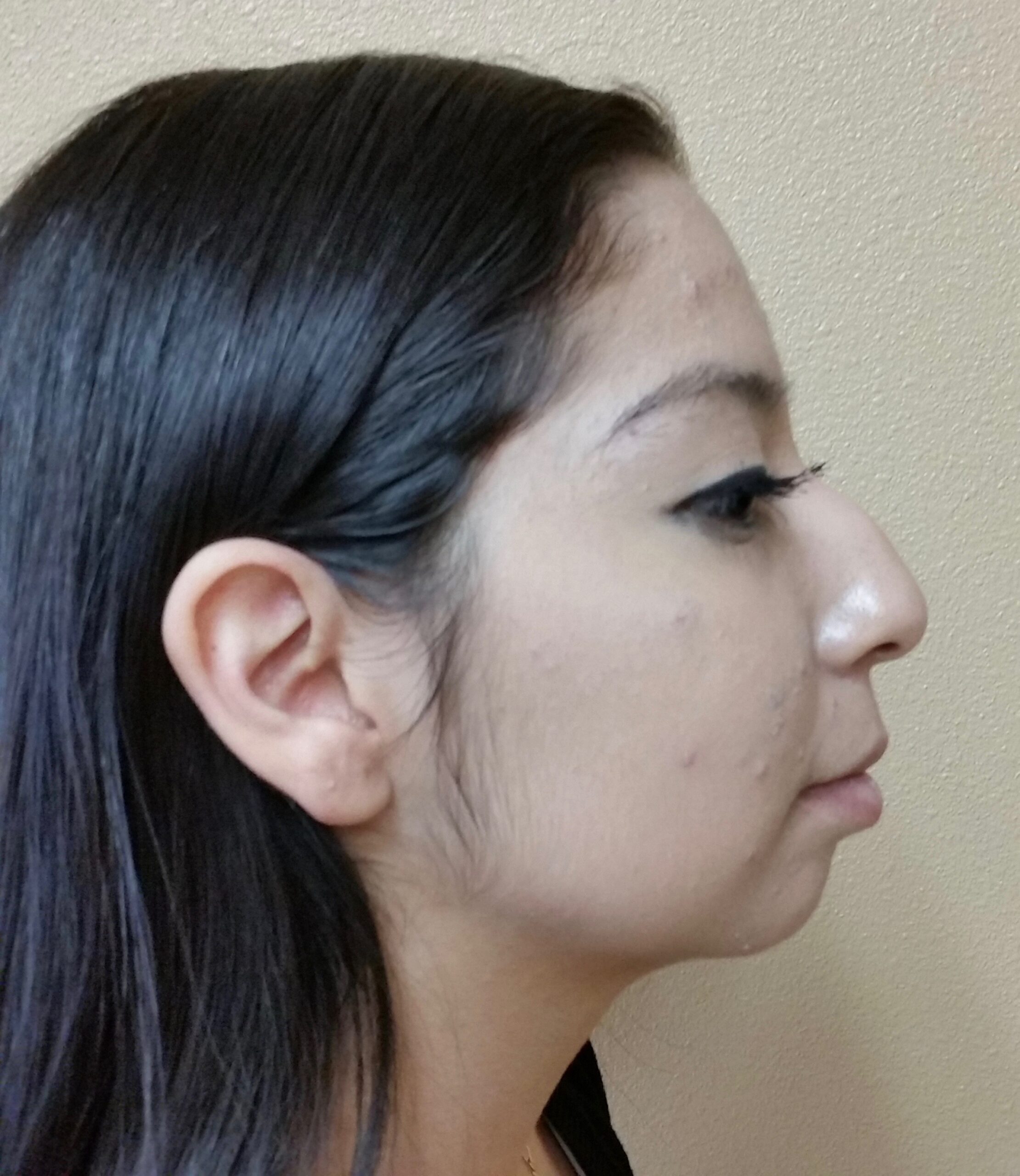 Rhinoplasty | Nose Surgery Patient Photo - Case 2367 - before view-1