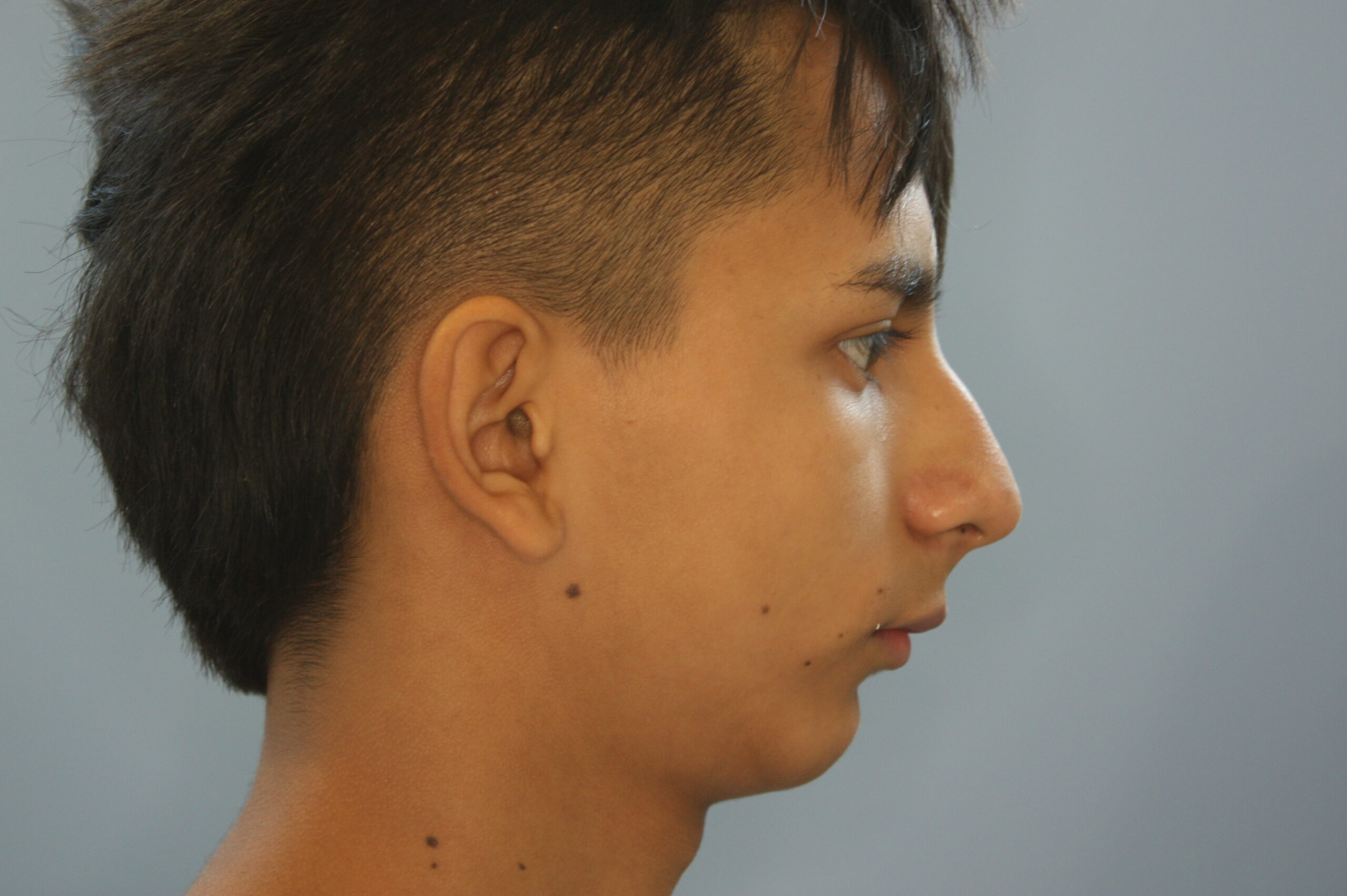 Chin Augmentation Patient Photo - Case 2373 - before view-1