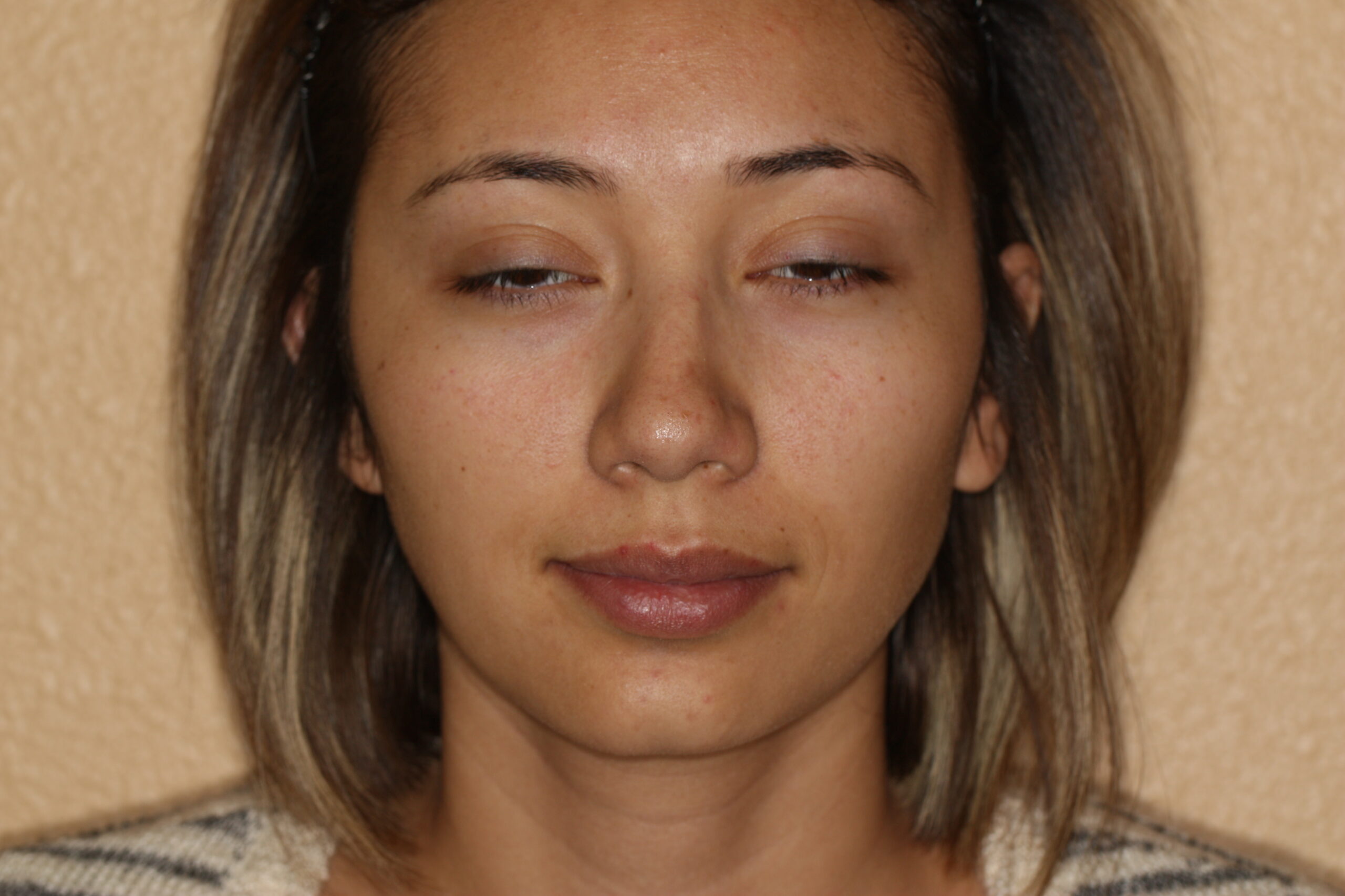 Rhinoplasty | Nose Surgery Patient Photo - Case 2394 - before view-