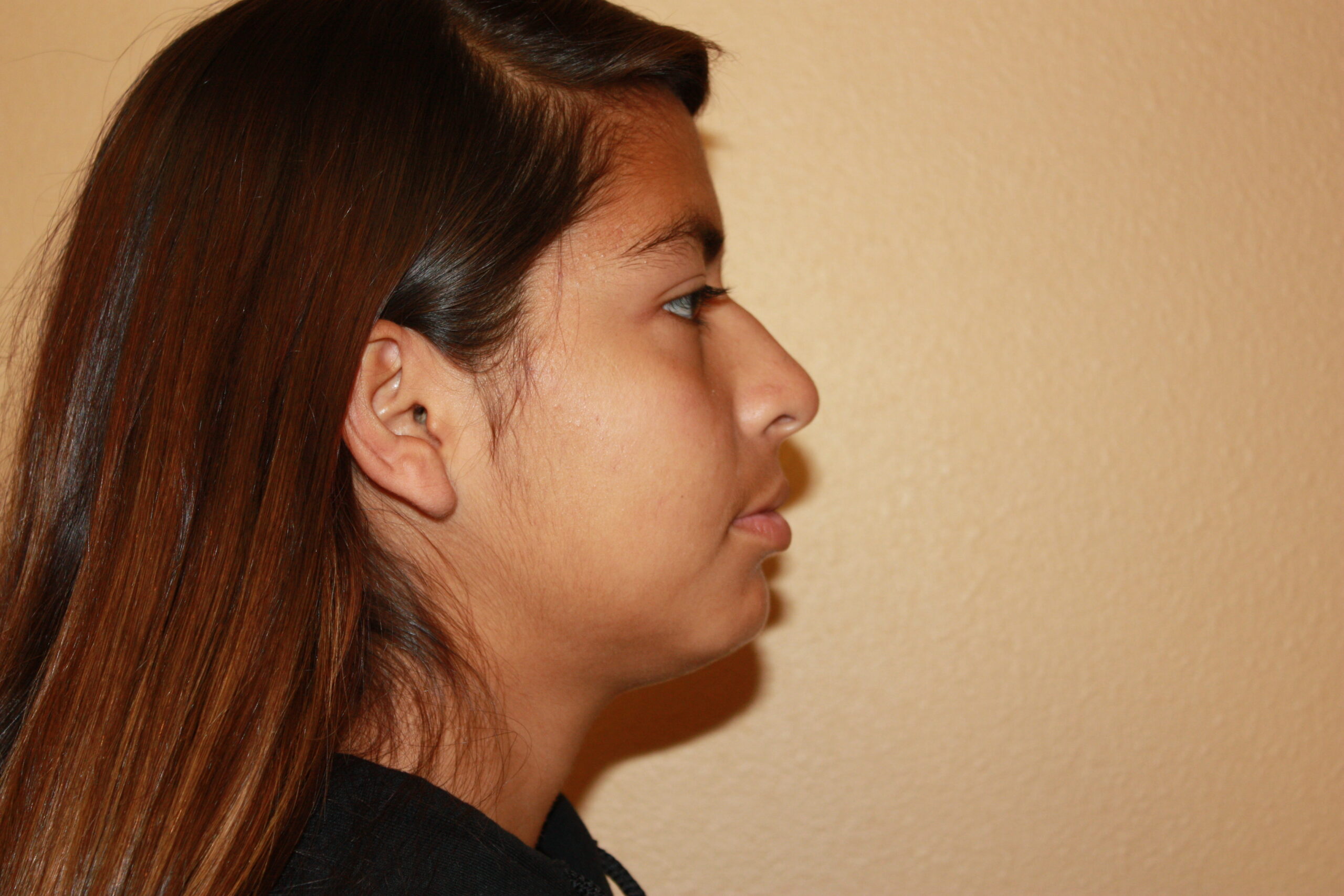 Rhinoplasty | Nose Surgery Patient Photo - Case 2400 - before view-1