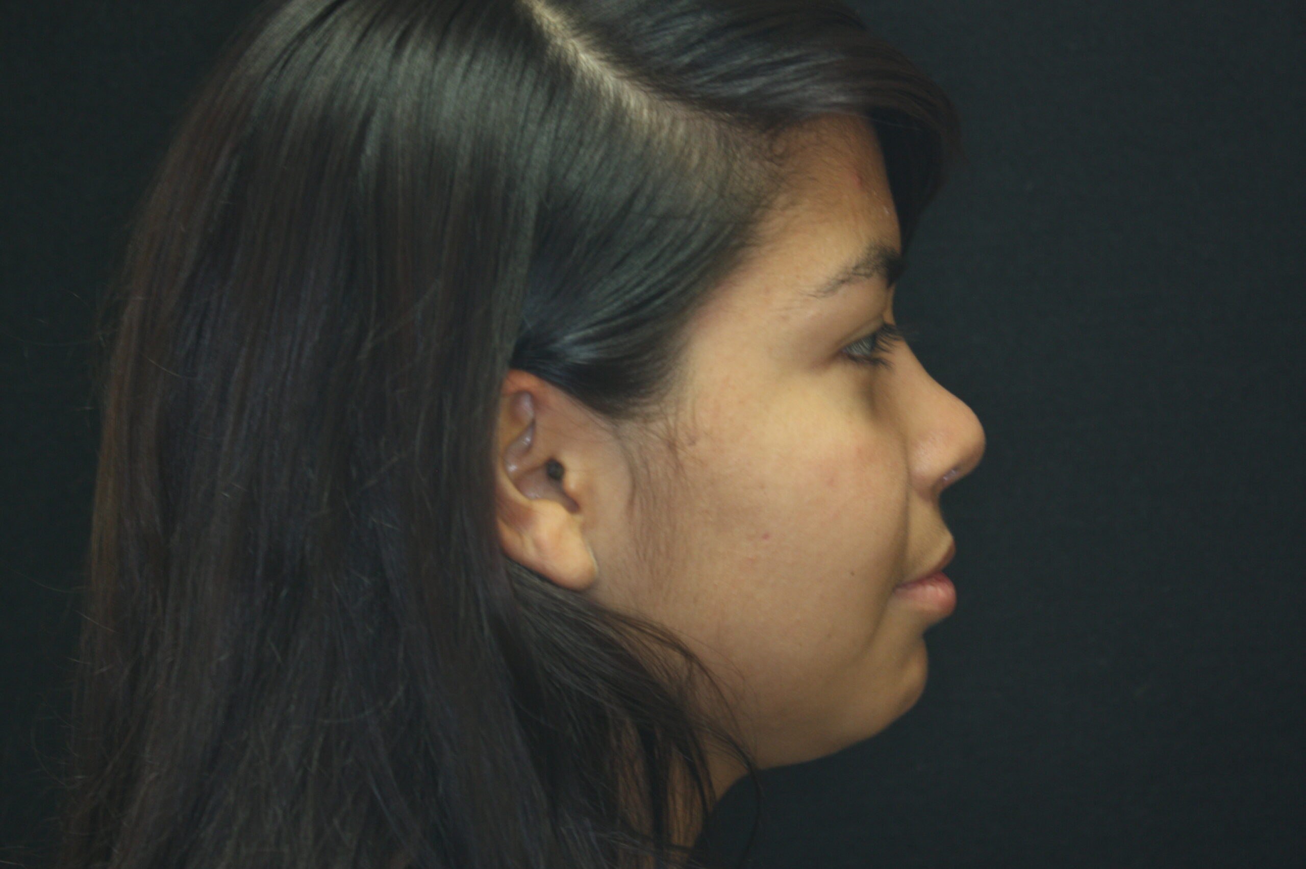Rhinoplasty | Nose Surgery Patient Photo - Case 2400 - after view-1