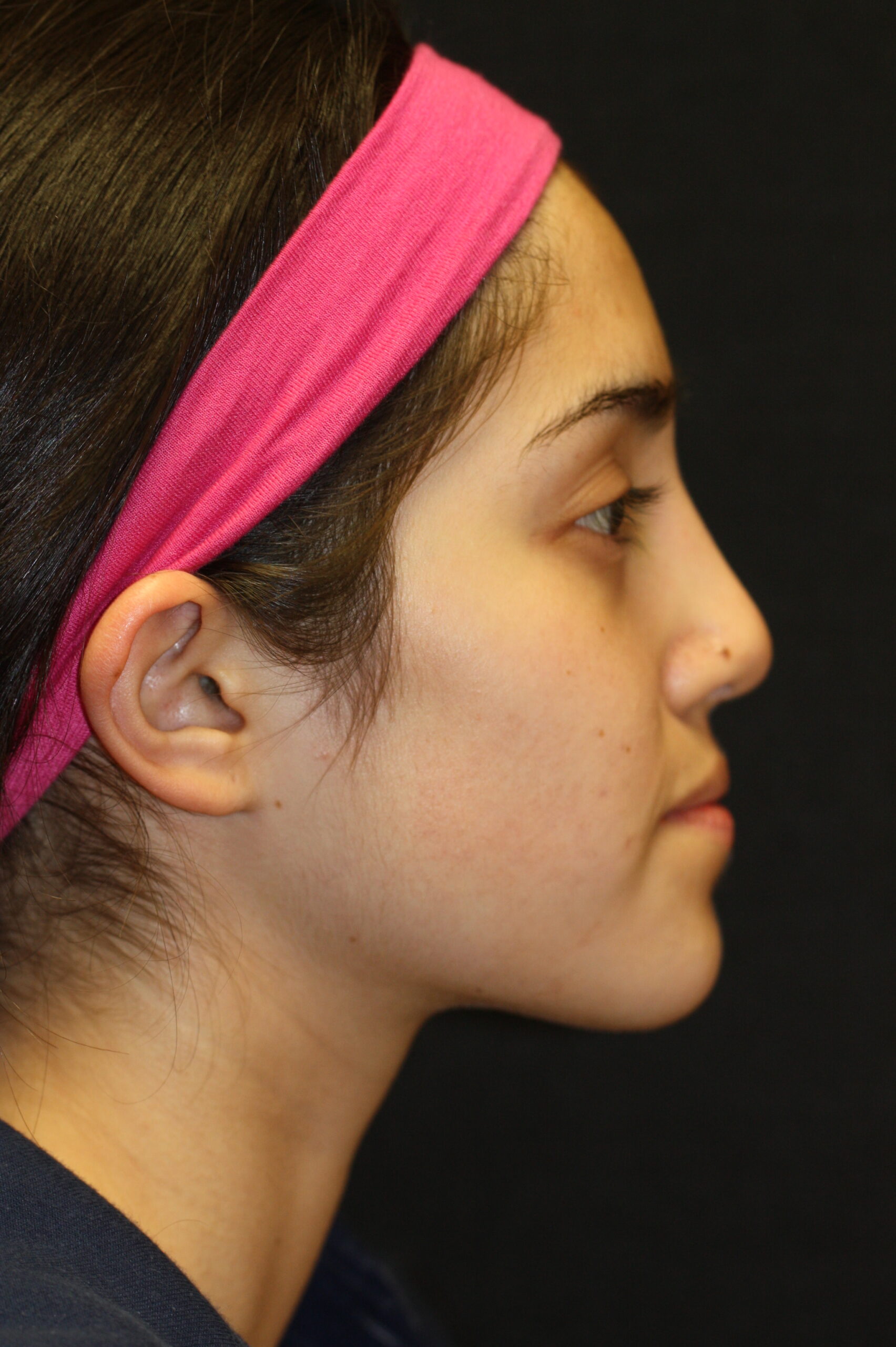 Rhinoplasty | Nose Surgery Patient Photo - Case 2478 - after view-1