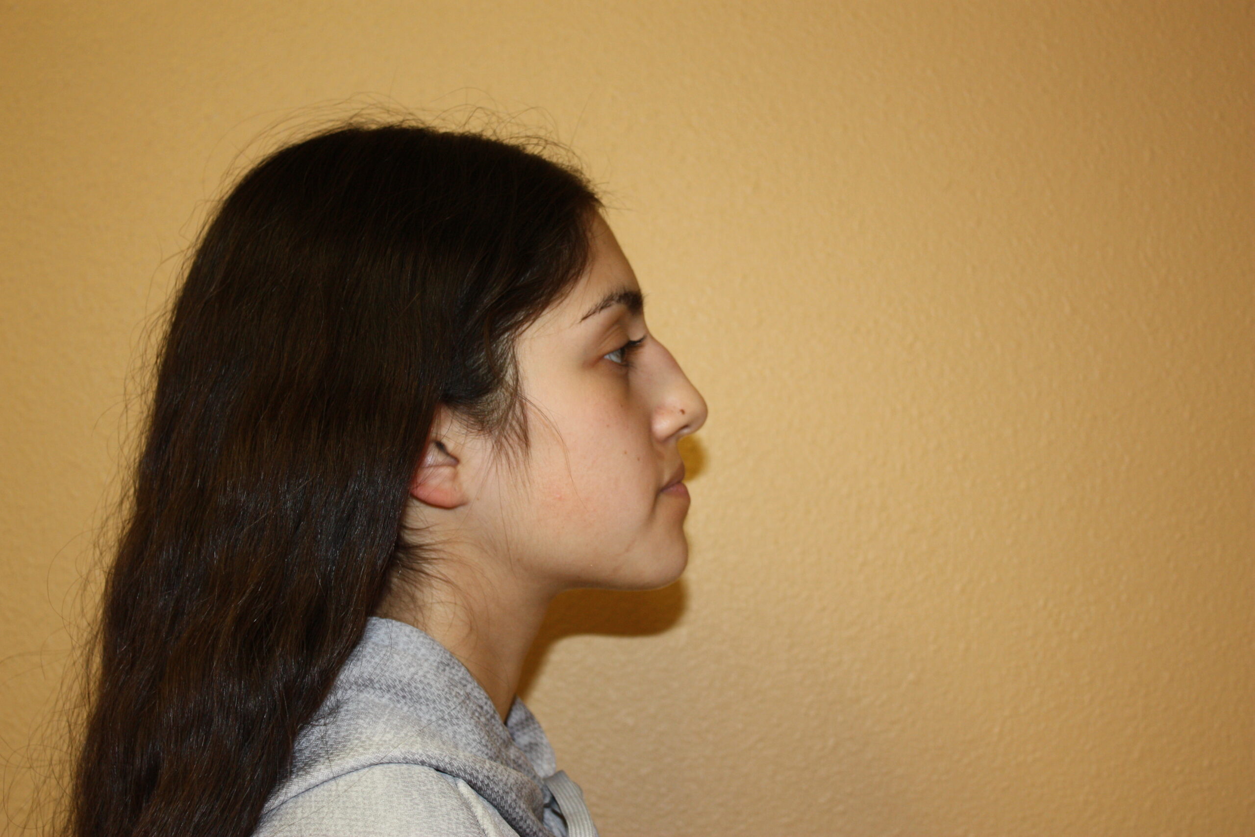Rhinoplasty | Nose Surgery Patient Photo - Case 2478 - before view-1