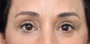 Brow Lift - Case 2654 - After