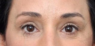 Brow Lift Patient Photo - Case 2654 - after view